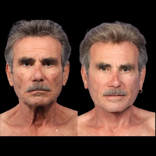 Male Neck Lift