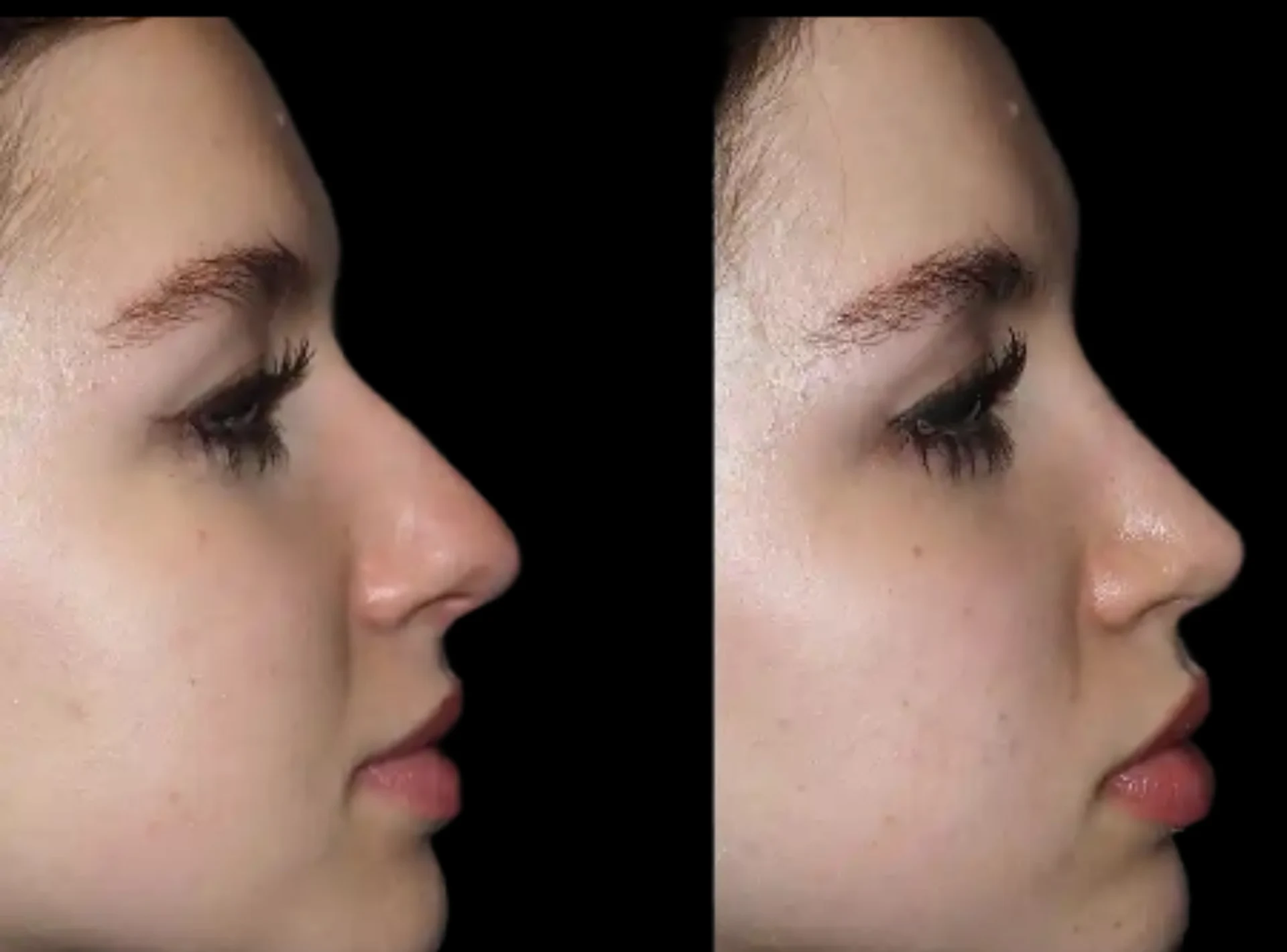 Rhinoplasty