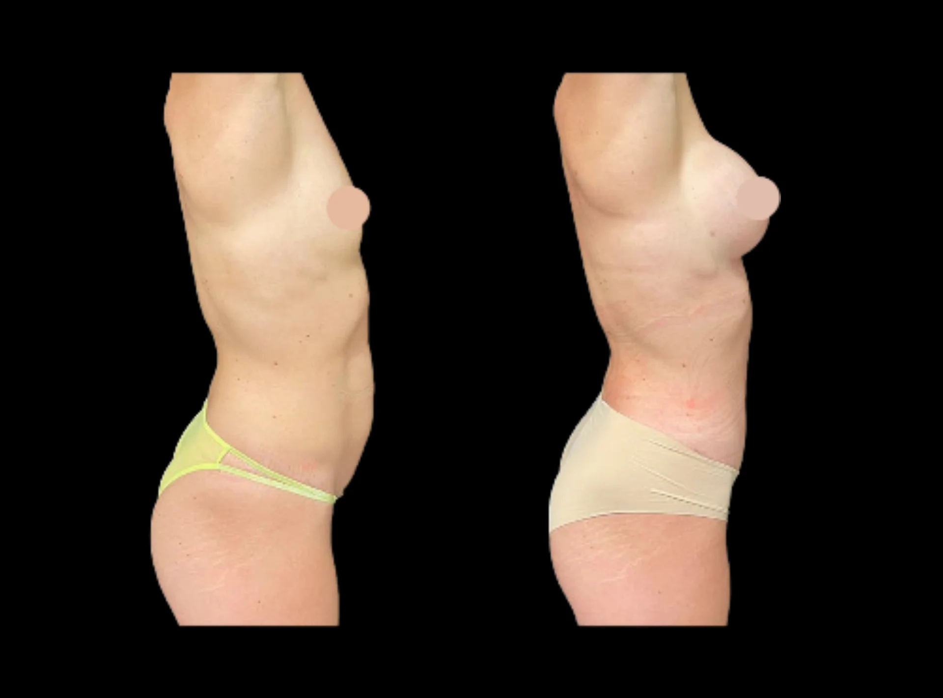 Breast Augmentation