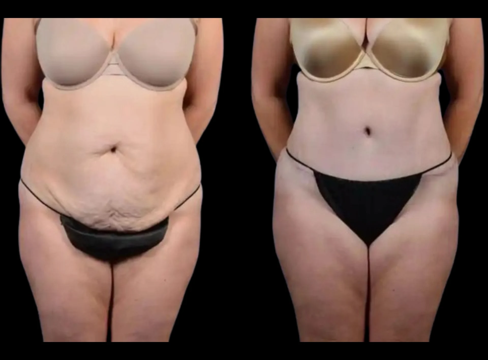 Tummy Tuck
