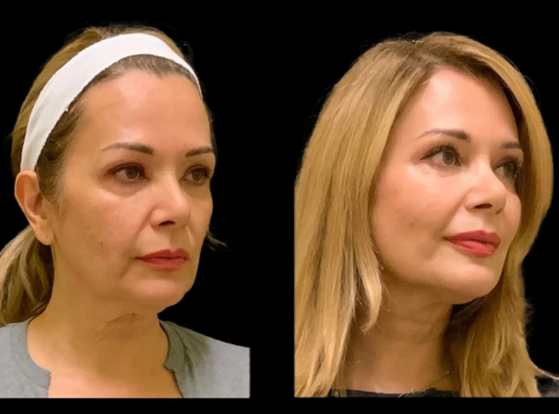 Cheek Augmentation