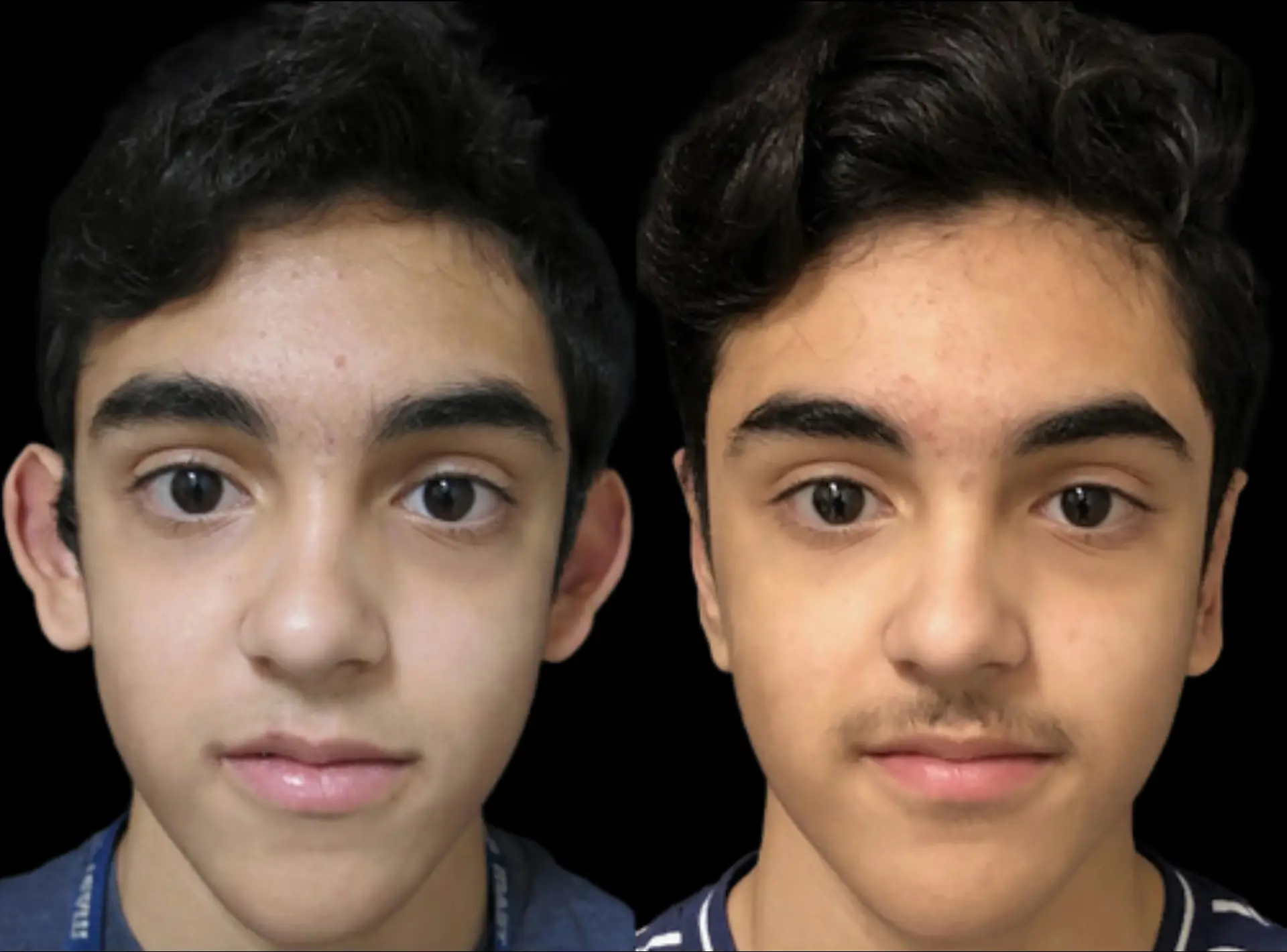 otoplasty