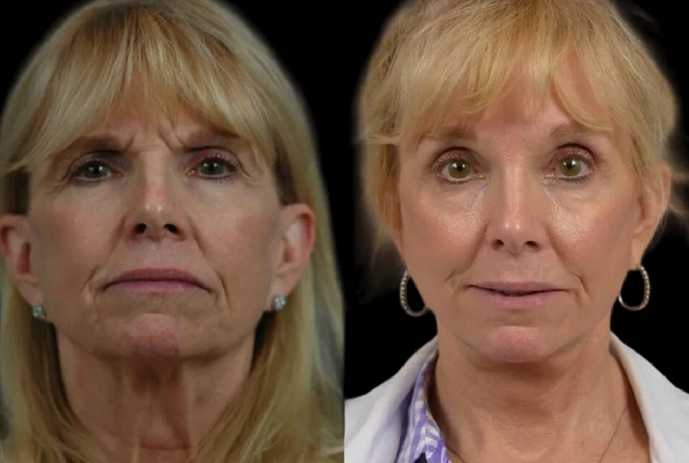 Face Contouring in Abu Dhabi