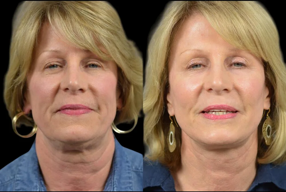 Face Contouring Before and After in Dubai