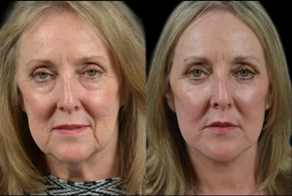 Face Contouring Before and After Images in Dubai