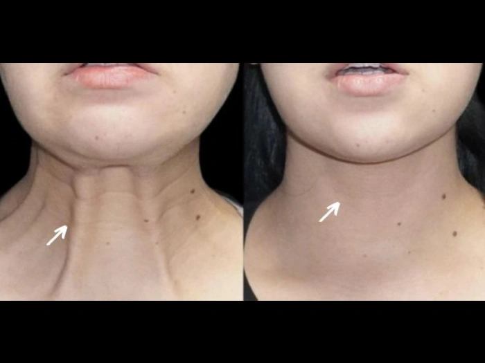 Skin Booster Injection in Abu Dhabi