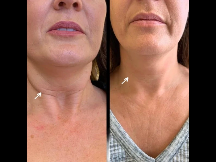 Salmon Dna Injection Before After Dubai