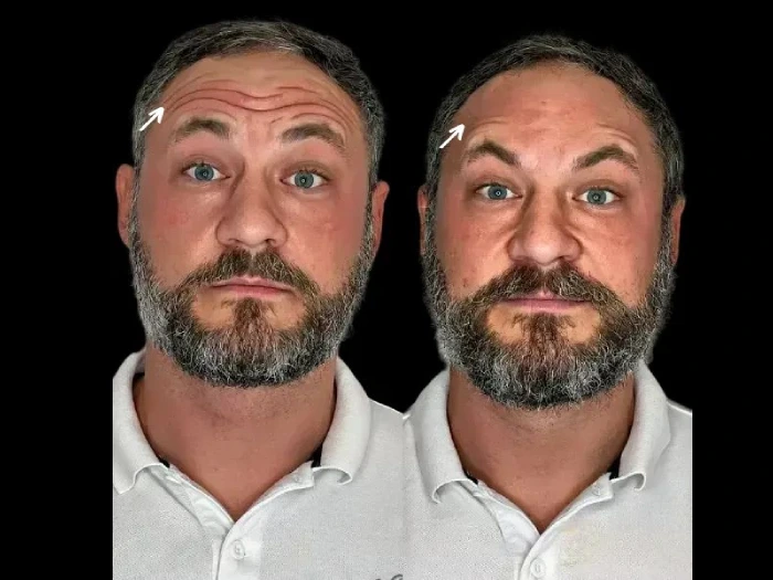 Skin Booster Injection Before After in Dubai