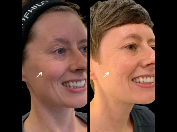 Skin Booster Injection Before After in Uae