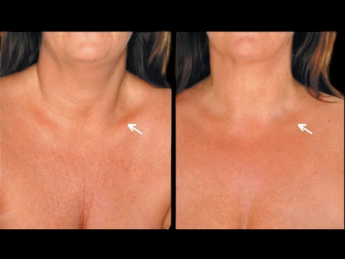 Skin Booster Injection Before After in Dubai