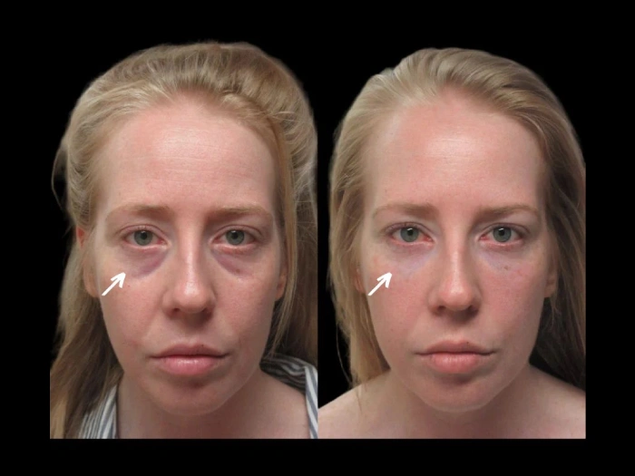 Salmon Dna Injection Before After