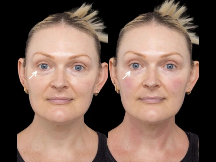 Salmon Dna Injection Before After Results