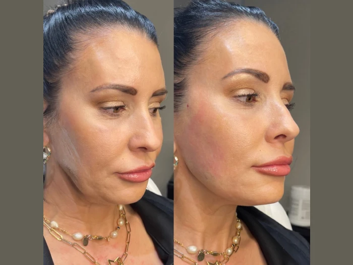 Thread Lift Pictures Before After