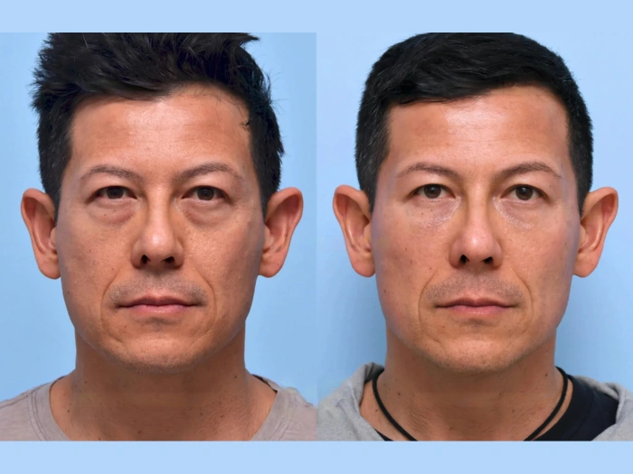 Mesotherapy Pictures Before After