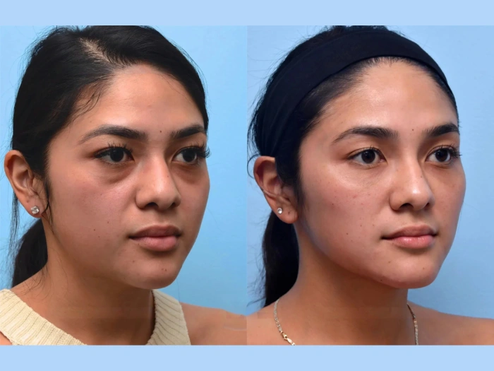 Mesotherapy in Abu Dhabi