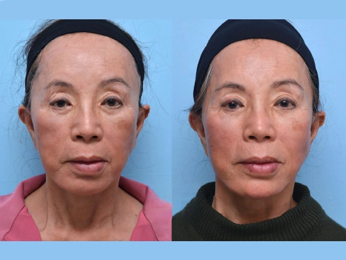 Mesotherapy in Dubai