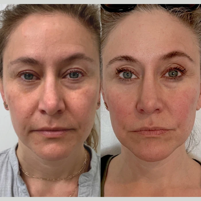 Exosomes Treatment Pictures Before After