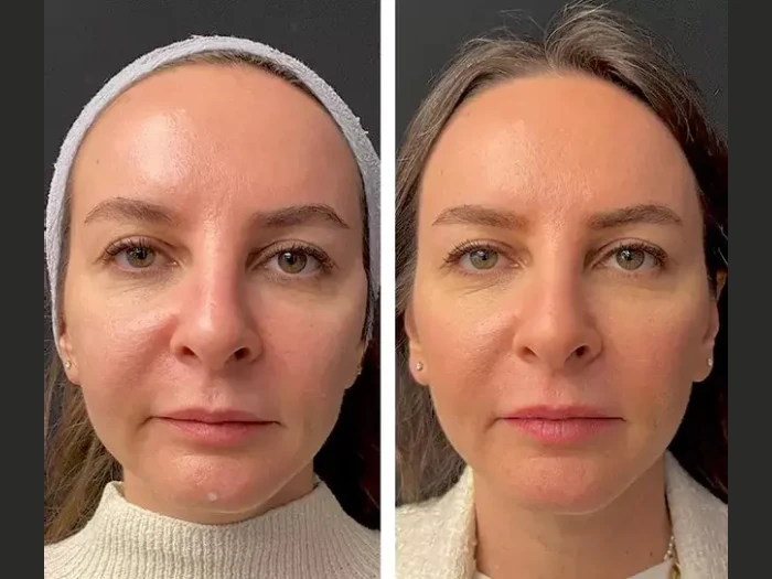Mesotherapy Before After at Perfect Drs