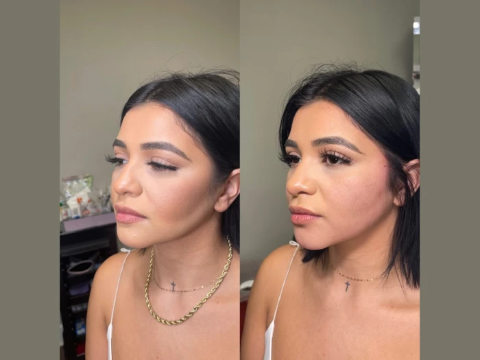 Thread Lift Perfect Drs Dubai