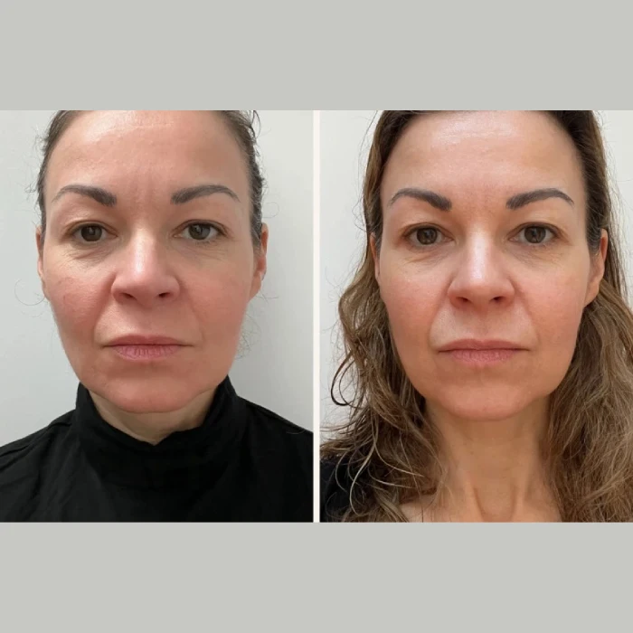 Exosomes Treatment Before After at Perfect Drs