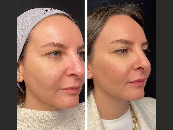 Mesotherapy in Uae