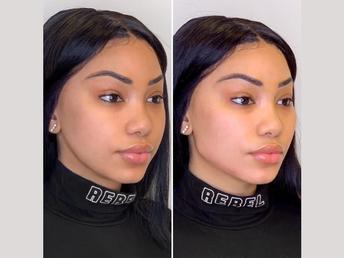 Thread Lift Before After