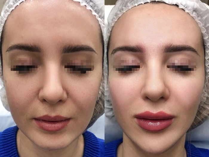 Jalupro Before and After Pictures