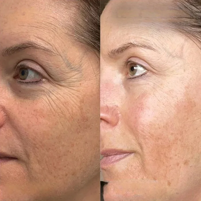 Exosomes Treatment Perfect Drs Dubai
