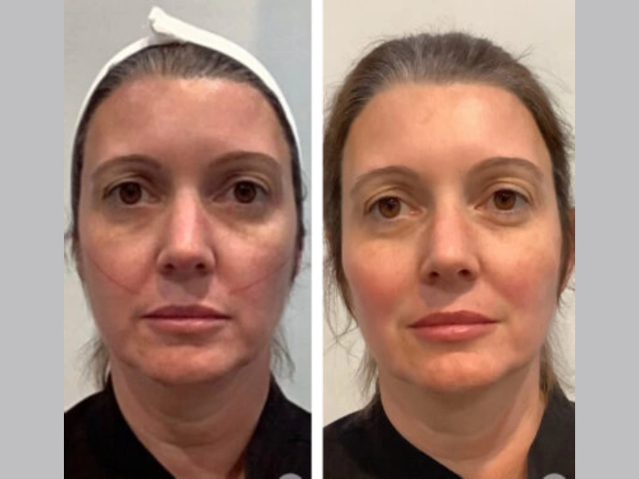Thread Lift Before After Images