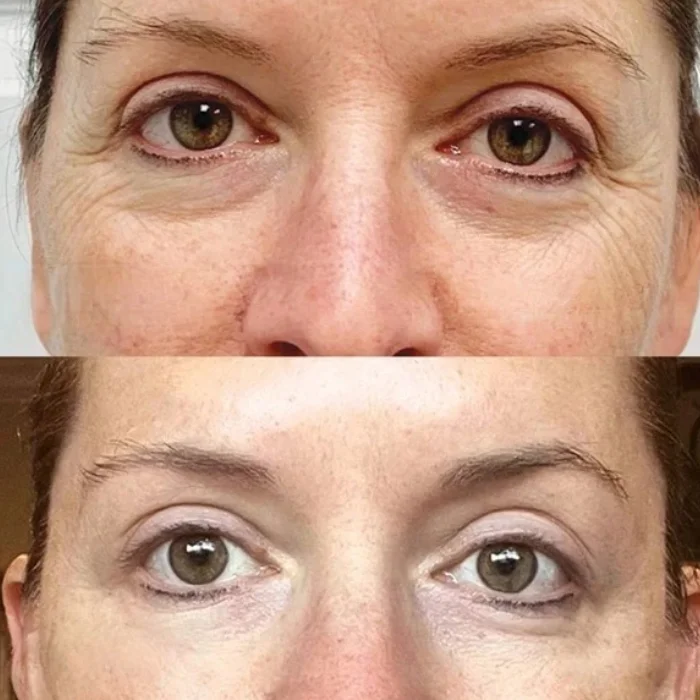 Exosomes Treatment Before After Abu Dhabi