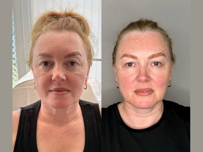 Jalupro Before and After Pictures in Dubai Uae