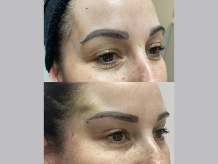 Thread Lift Pictures Before After