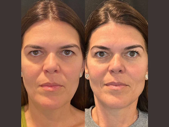 Thread Lift Before After