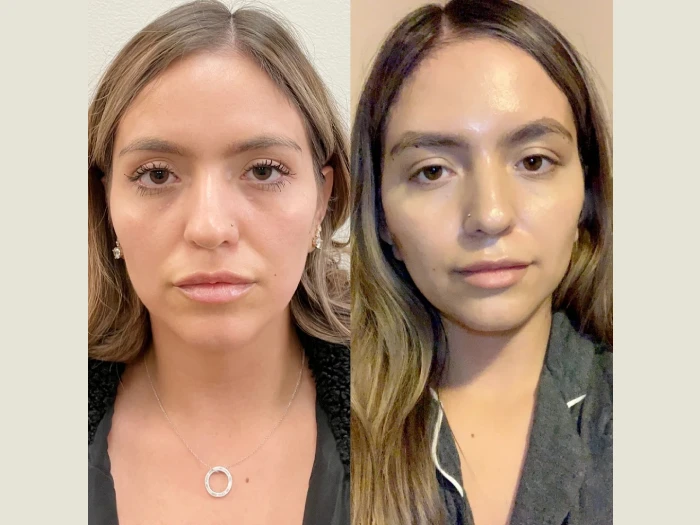 Thread Lift Before After Pictures