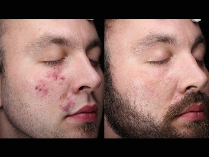 Birthmark Removal at Perfect Drs Dubai