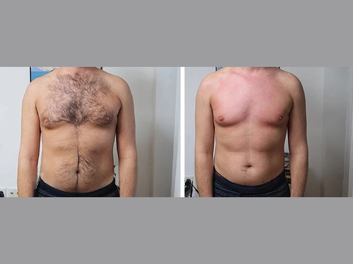 Male Laser Hair Removal Pictures Before After