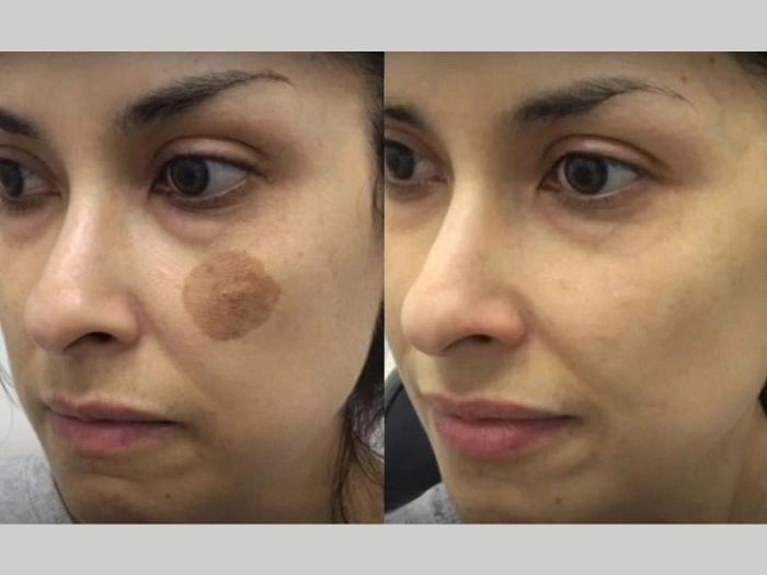 Birthmark Removal Results in Dubai