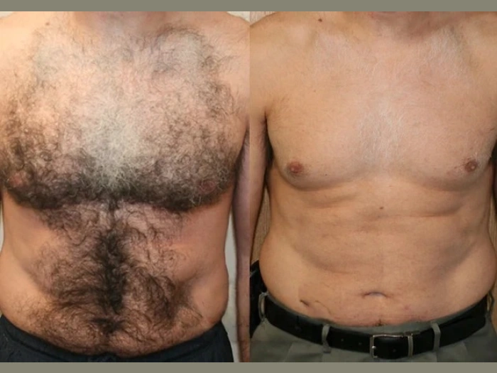 Male Laser Hair Removal at Perfect Drs Dubai