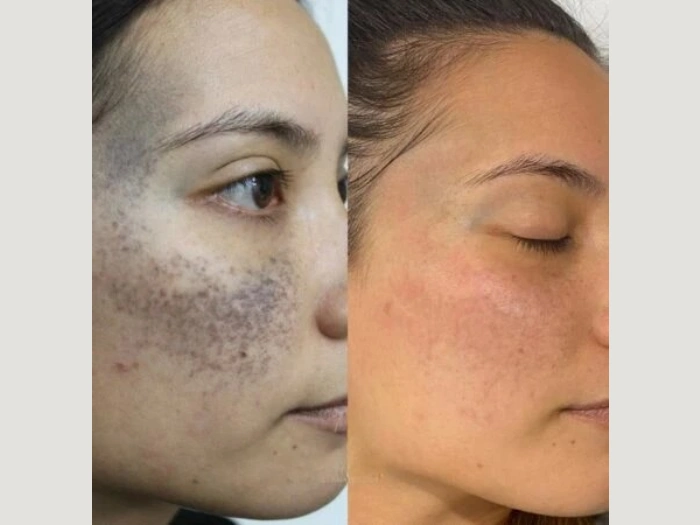 Birthmark Removal Pictures Before After