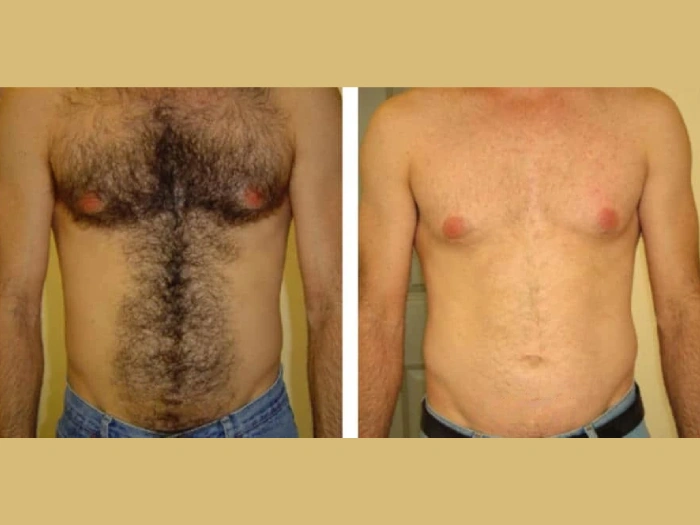 Male Laser Hair Removal Results in Dubai