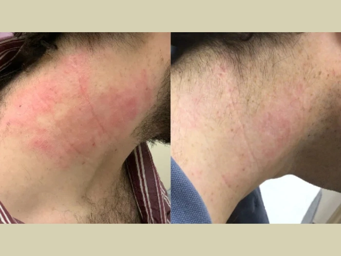 Birthmark Removal Before After Pictures