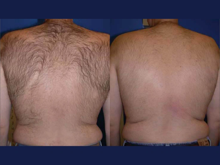 Male Laser Hair Removal Before After Pictures