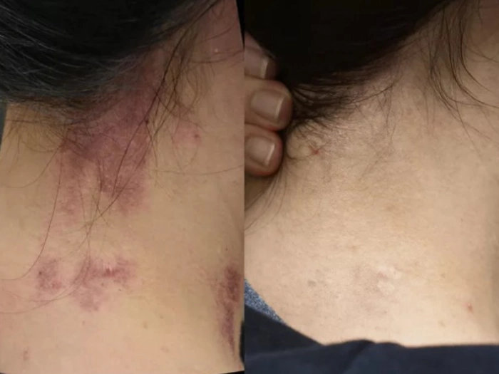 Birthmark Removal in Dubai