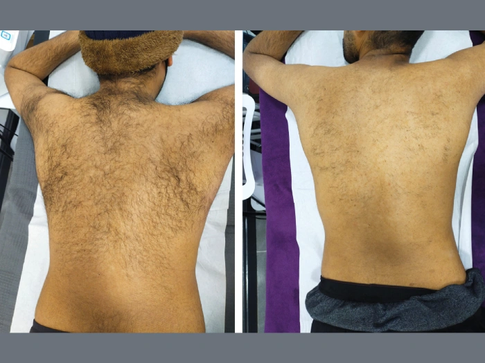 Male Laser Hair Removal in Dubai