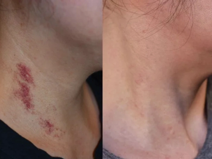 Birthmark Removal Before After Abu Dhabi