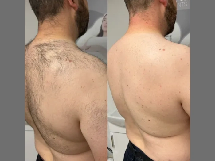 Male Laser Hair Removal Before After Abu Dhabi
