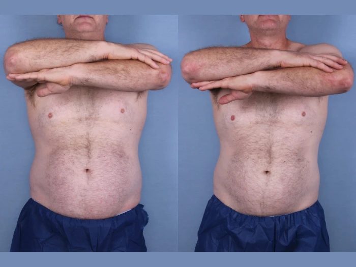 Coolsculpting Before After Uae