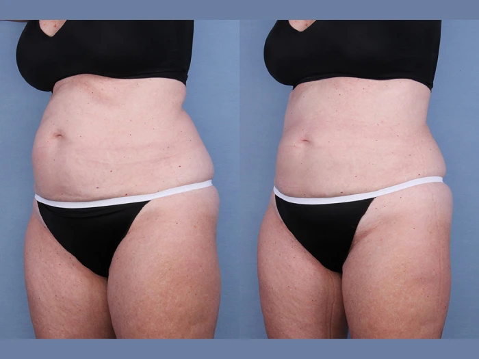 Coolsculpting Before After Abu Dhabi