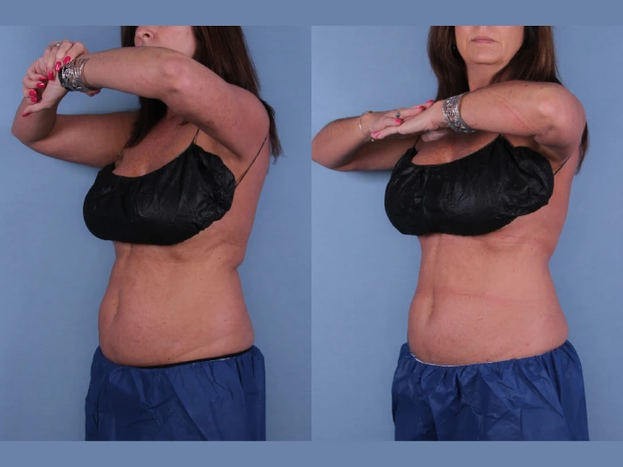 Coolsculpting Before After Result in Uae