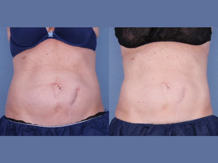 Coolsculpting in Uae